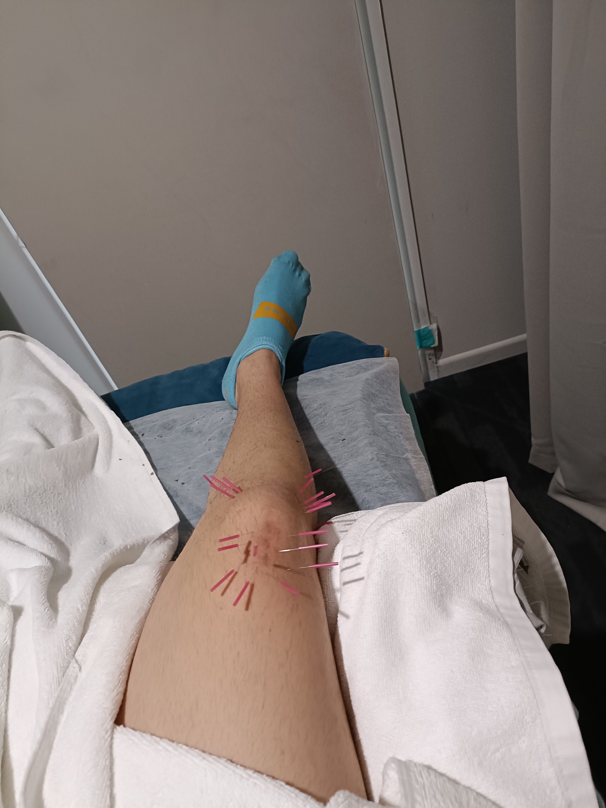 Acupuncture needles placed along a patient's knee and lower leg during a treatment
